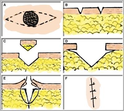 SF method for removing small skin melanocytic nevus